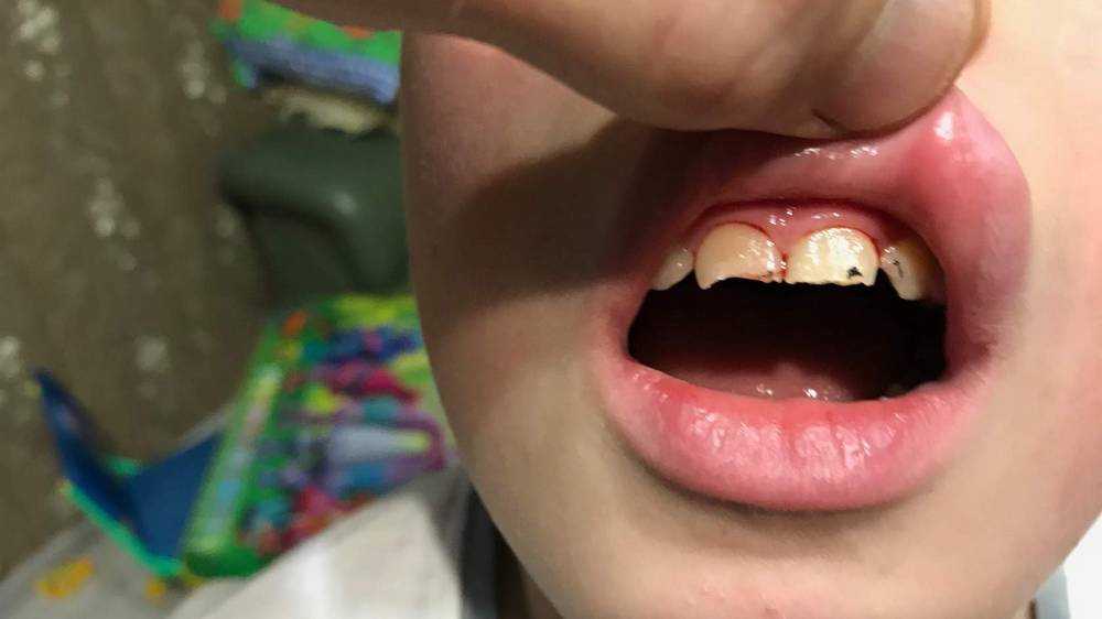 В суд Новозыбкова обратились родители ребенка, которому повредили зубы