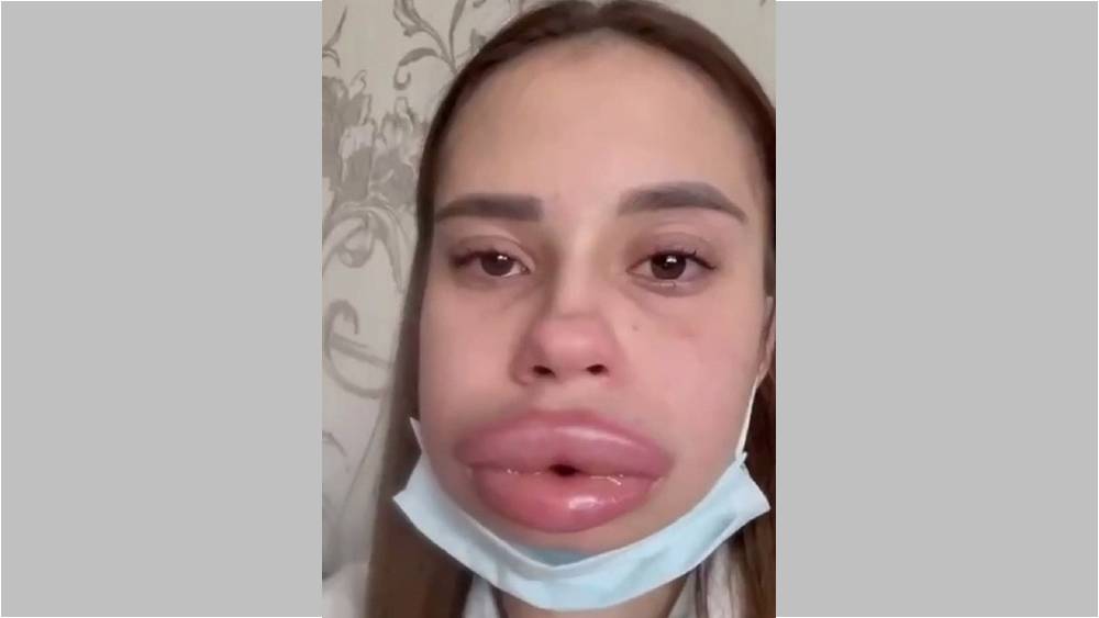 Попытка девушки «сдуть» губы привела к ужасающим последствиям