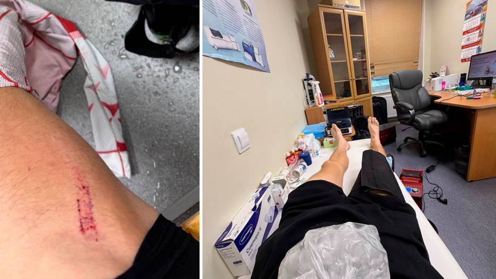 Бакуров показал повреждение после грубого нападения брянского лыжника Большунова